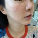 부산 해운대 슈퍼젝션 효과 통증 가격 후기 디엘르 에스테틱