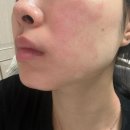 [피부관리] 내돈내산 LDM 후기, 가격: 여의도 피부과/ 강남 피부과/ LDM 메드 Med / LDM 트리플 Triple