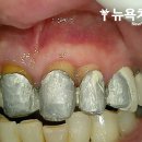 동호아름다운치과의원 | 인천남동구치과, 앞니 브릿지 속 금속 노출 재료를 바꿔 치료해드린 사례