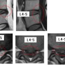 글라 님의 요추디스크 L4-5, 척추관 협착증의 MRI 사진 판독입니다. 이미지