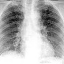 비특이성 간질성 폐렴[non-specific interstitial pneumonia, NSIP] 이미지