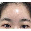 그날성형외과의원 | 그날성형외과 후기, 20대 이마거상술