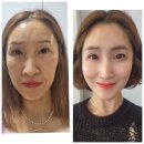 10명중 9명이 반대하는 인셀덤 SGM을 선택한 이유. (찐 후기)