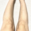 닥터손유나의원 지방분해주사 종아리캣 2회차로 종아리 완전 얇아졌어요!