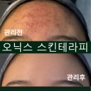 오닉스 | 왕십리 에스테틱 여드름 압출 추출 및 문제성 피부 관리 잘하는 곳 오닉스 스킨테라피 솔직후기