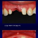 상악 전치 ovate pontic 이미지