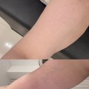 연산동피부관리 리하에스테틱 테라노바 팔뚝