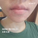 위드로케어 | 입주위아토피에 암앤하머치약 효과? 입주변아토피 암앤하머치약 사용후기/ 구순염 완치 방법