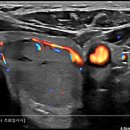 Core needle biopsy 이미지