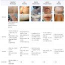 엠폭스(원숭이두창) 증상 및 <b>국내</b> <b>발생</b> <b>현황</b>