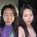 이다듬 디지털 덴탈랩 | 강남역피부과 이브타이탄 리프팅 + 팔자필러로 중안부 축소 후기