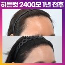 [30대 각진 M자 이마 여자 모발이식 후기] 비절개 히든컷 2400모 2주, 3개월, 1년 변화과정 (모엠의원/헤어라인/전지훈원장) 이미지