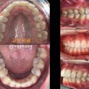 미켈란치과의원 | 강남 치과 미켈란 심한 돌출입 사랑니 발치 추천 후 치아 교정 소요 기간은?