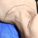 몸과맘한의원 | 강남역 편평사마귀 한의원 : 목 편평사마귀 쥐젖 거우침으로 제거 후기