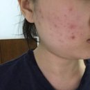 나을한의원 | 리유한의원 강남본점에서 받은 피부 심부재생치료 효과 기간 가격 후기