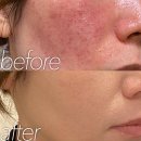 민들레 약국 | 10년 묵은 고민 해결! 5만원대 약국 연고로 피부홍조 탈출하는 법