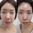 파발로 | 경기광주에스테틱 이프유스킨 리프팅 관리 후기, 팔자주름 개선 효과 제대로