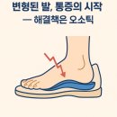 저이요족발 | 변형된 발을 교정하는 맞춤형 오소틱의 효과