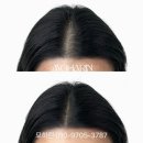 분당-160 | 분당 두피페인팅 전문, 풍성한 머리로 10년 젊어진 솔직 후기