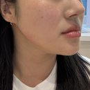 내돈내산 수지구청피부과 사각턱보톡스 제오민 100유닛 후기