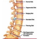 질병=질환(disease) 과 손상(injury) 4-2 편 목 디스크의 진행 이미지