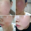 안면 홍조 가려움 주사피부염 오돌토돌 화장품 추천 지루샵 세라케어 울트라 스킨 로션