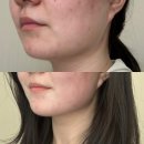 레브트레이닝 | [웨딩관리] 원주웨딩관리 젠에스테틱 원주피부관리, 미레브 라인업케어로 숨겨진 턱선 발굴