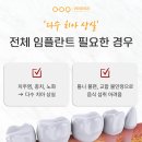 장성치과의원 | 장성치과 다수의 치아를 상실했을 때? 전체 임플란트