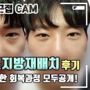 [4K] 눈밑지방재배치로 깔끔해진 인상, 20대 남성의 눈밑은 어떻게 달라졌을까? 이미지