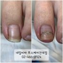 네일비타&푸스케어(건대점) | 건대내성발톱, 네일비타&amp;푸스케어 건대점에서 고민해결 했어요~