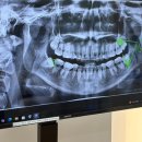 참사랑주치과의원 | 10. 사랑니 니가 뭔데 사랑을 붙여🦷