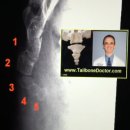 꼬리뼈 골절 - X-rays showing Coccyx fracture (broken tailbone) 이미지