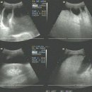 Liver cirrhosis & Ascitis & Splenomegaly & sludge ball(GB) 이미지