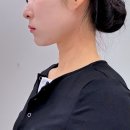 한올한올 | 대전 이중턱 하프한 윤곽관리 올타이트리프팅 600샷 내돈내산 후기