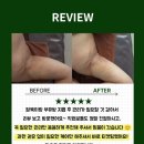 더새로이의원 | 송파사후관리ㅣ송파 팔뚝·부유방 지흡 사후관리! 딱 필요한 케어로 완성한 슬림핏👍🏻