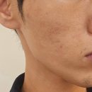 세정한의원 | 홍대한의원 화침 시술 후기｜홍대피부과에서 체험한 맞춤형 남자 여드름 관리와 피부 회복 과정