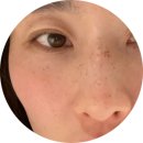 오늘,맑음의원 | 장유 율하 오늘더맑음피부과 기미 색소침착 gv레이저 시술 후기