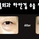 하안검,눈밑수술 방법 [대구성형외과,대구지방이식,대구보톡스] 이미지