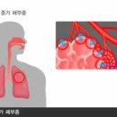 호흡곤란, 흉통, 기침 등 폐부종 증상과 원인 노인 위험 이미지