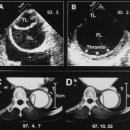Different remodeling of descending thoracic aorta after acute event in aortic intramural hemorrhage versus aortic dissection 이미지