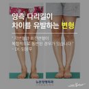 2-2. 다리길이차이, 불균형의 원인과 치료방법은? 목동역 뉴본정형외과 이미지