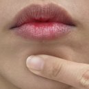 뚜뚜의원 | 자갈턱 보톡스 2달 후기 (리터치, 돌출입, 부작용, 가격 등)