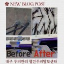 대구 동성로 웰킨두피탈모센터 지루성두피염 두피관리 케어 후기