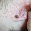 건점 | 튀어나온점제거비용 9mm 왕점 큰 점 빼는 가격 후기