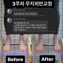 무지 외반증 교정 운동으로 개선했어요!