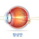 원시 근시 난시 뜻 차이 각각 다른 점과 테스트 방법 이미지