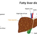 지방간 원인 지방간 방법 예방 지방간에 좋은 음식 이미지