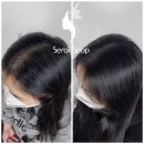 새로이숲부평 | 효과좋은 탈모커버 방법, 인천 두피문신 SMP란 무엇인가