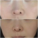 부산 센텀피부과 포텐자 모공관리 내돈내산 후기 전후비교