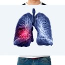 폐에는 ‘통증 세포’ 없어서 암 조기 발견 어려워… 검사 꼭 받아야 하는 때는? 이미지